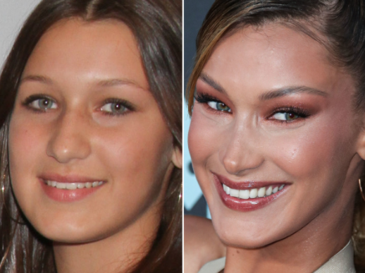 Bella Hadid Nose Job Before And After Images Of Her Plastic Surgery