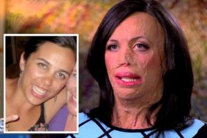 Turia Pitt Before and After Burns