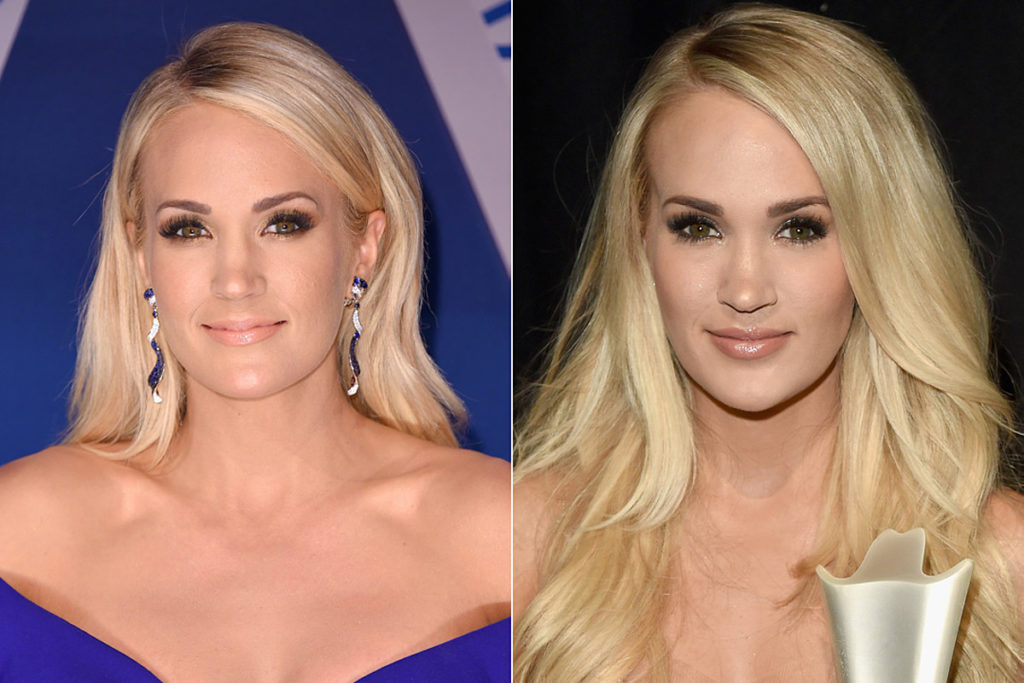 Before And After Photos Of Carrie Underwood’s Accidental Injury To Her Face|All Social Updates